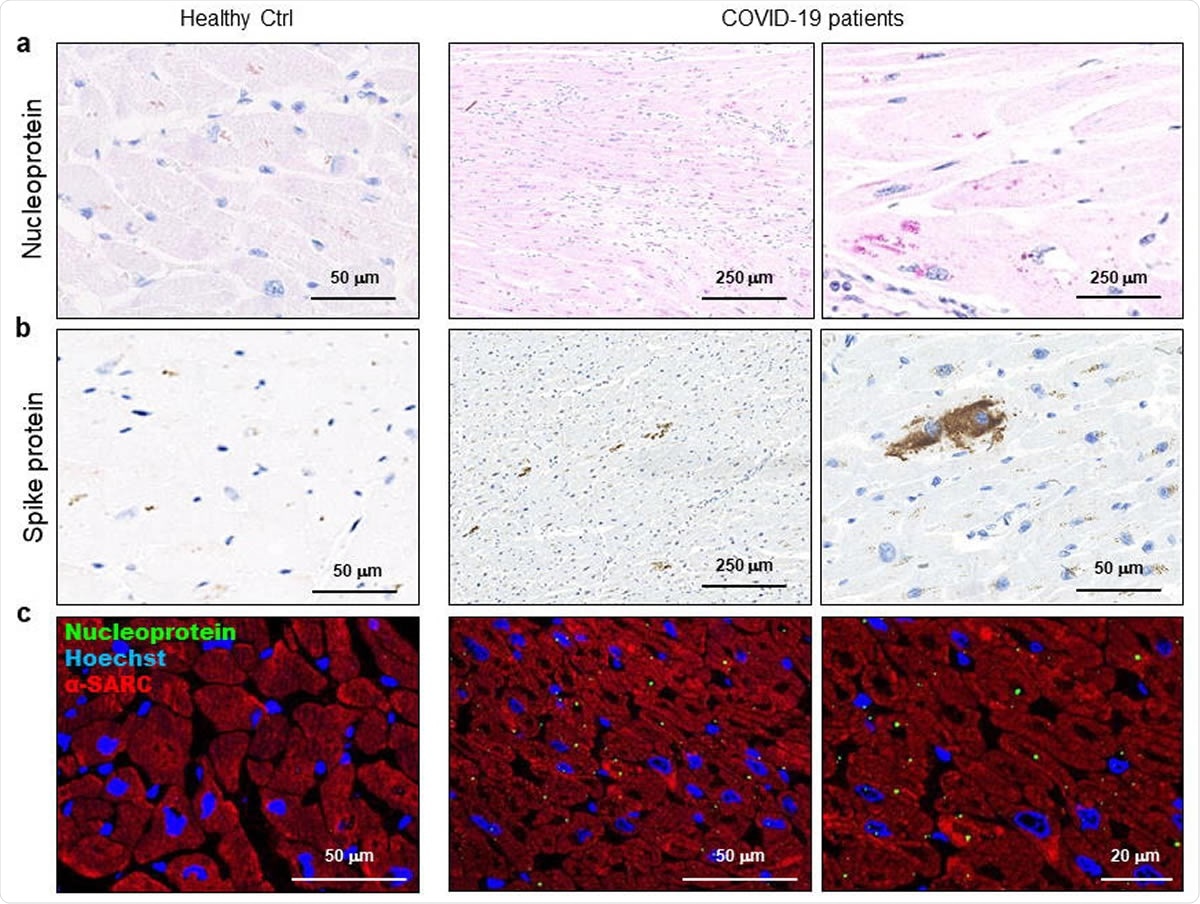 SARS-CoV-2 proteins are detectable in cardiomyocytes of COVID-19 patients. a-b) Representative images of immunohistochemistry assays on 3μm-slides of formalin-fixed paraffin-embedded left ventricle specimens from healthy control (Healthy Ctrl, left panels) and COVID-19 patients (COVID-19, central and right panels) for SARS-CoV-2 nucleoprotein (a, in red) and spike protein (b, in brown). c) Representative images of immunofluorescence assay on 3μm-slides of formalin-fixed paraffin-embedded left ventricle specimens from healthy control (Healthy Ctrl, left panels) and COVID-19 patients (COVID-19, central and right panels) for SARS-CoV-2 nucleoprotein (green) and sarcomeric α-actin (α-SARC, red). Nuclei have been stained by Hoechst (blue). Magnification as scale bars.