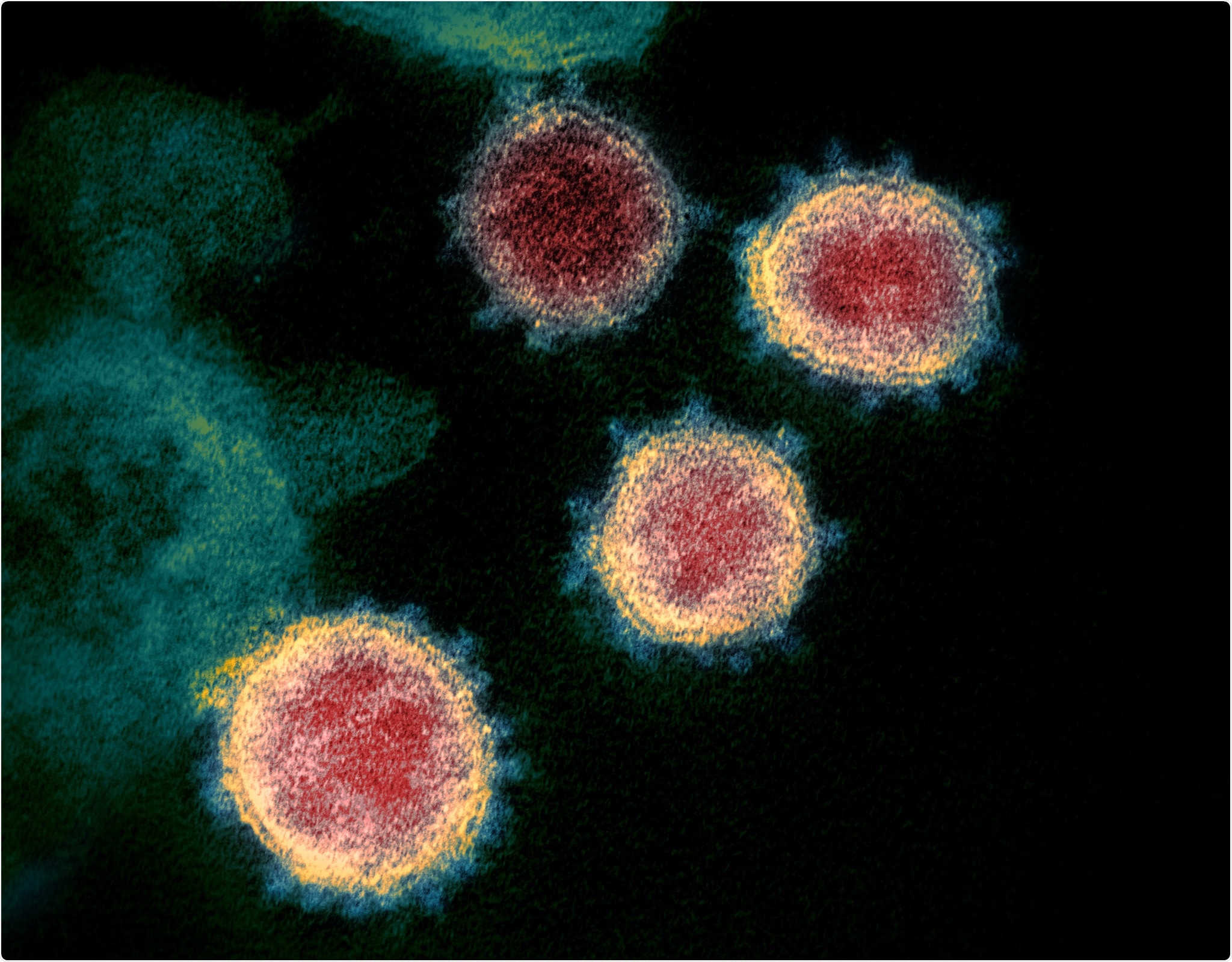 transmission electron microscope image shows SARS-CoV-2—also known as 2019-nCoV, the virus that causes COVID-19—isolated from a patient in the U.S. Virus particles are shown emerging from the surface of cells cultured in the lab. The spikes on the outer edge of the virus particles give coronaviruses their name, crown-like. Image captured and colorized at NIAID