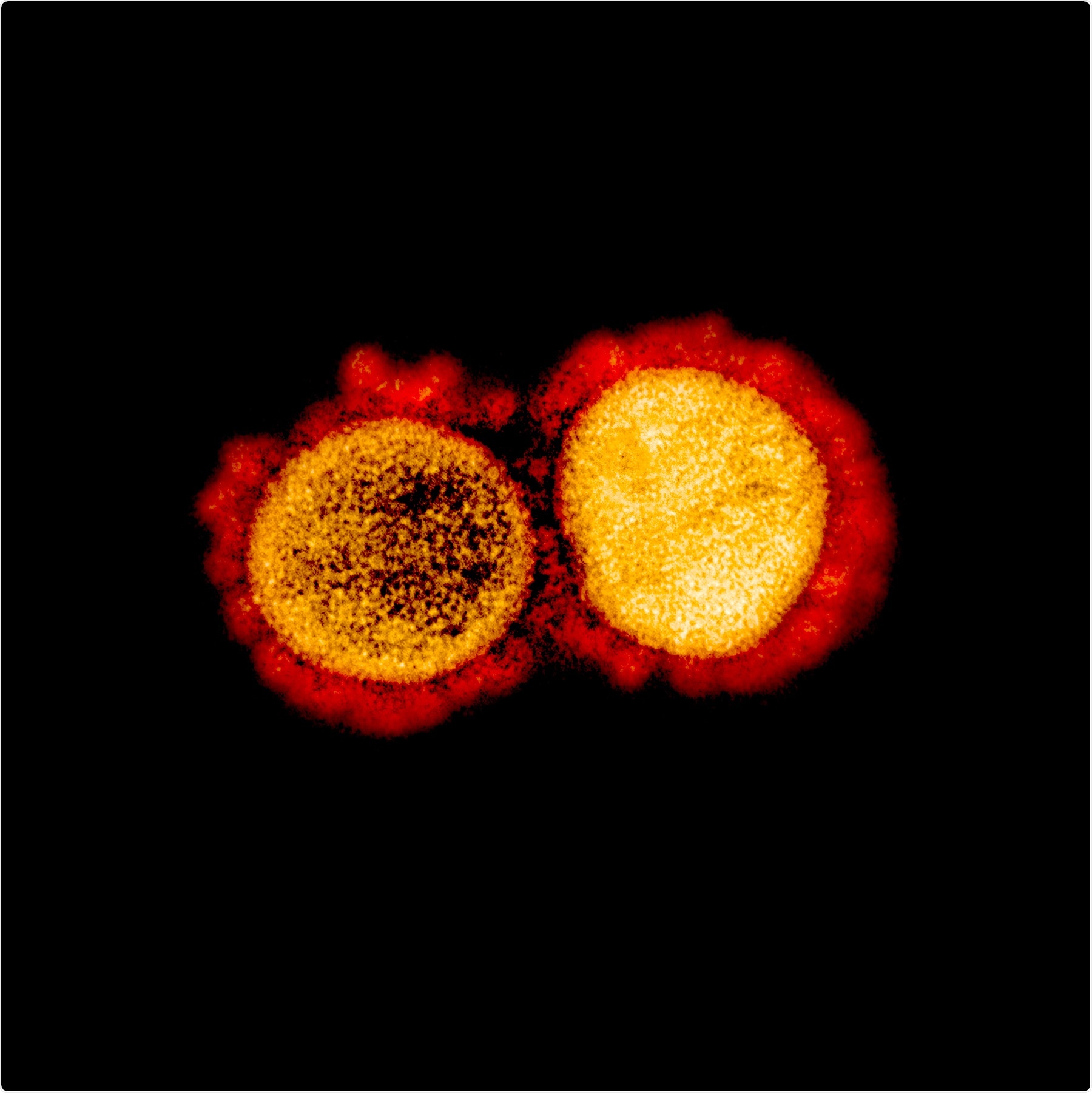 ransmission electron micrograph of SARS-CoV-2 virus particles, isolated from a patient. Image captured and color-enhanced at the NIAID Integrated Research Facility (IRF) in Fort Detrick, Maryland. Credit: NIAID
