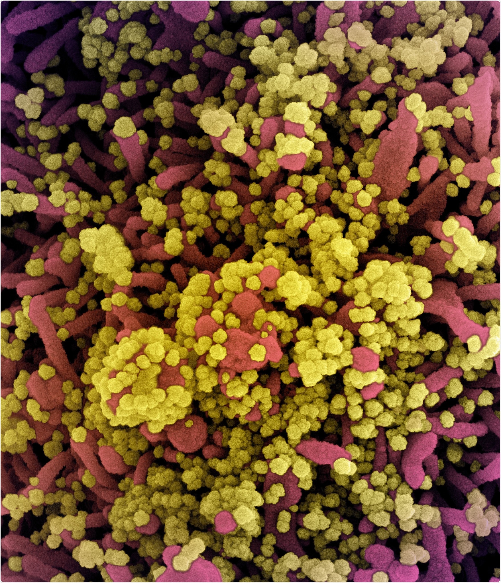 Colorized scanning electron micrograph of a cell heavily infected with SARS-CoV-2 virus particles (yellow), isolated from a patient sample. Image captured at the NIAID Integrated Research Facility (IRF) in Fort Detrick, Maryland. Credit: NIAI