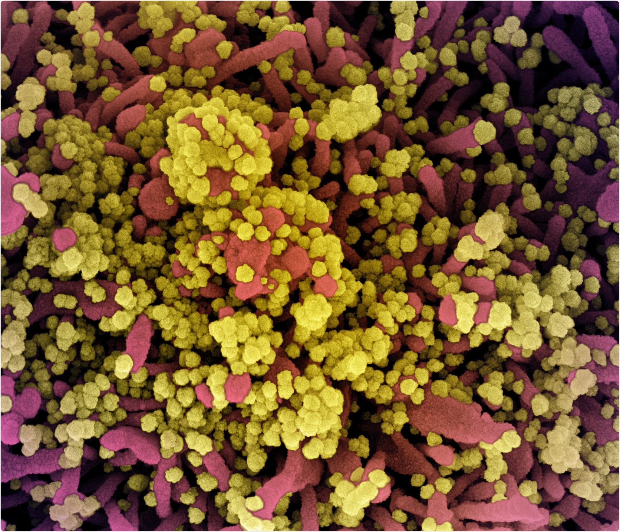 Colorized scanning electron micrograph of a cell heavily infected with SARS-CoV-2 virus particles (yellow), isolated from a patient sample. Image captured at the NIAID Integrated Research Facility (IRF) in Fort Detrick, Maryland. Credit: NIAID