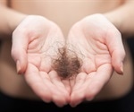 Recovered COVID-19 patients report hair loss months after infection