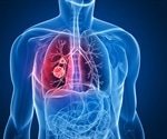 Recent Advancements in Lung Cancer Treatment