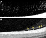 Inflammation in the eye after COVID-19