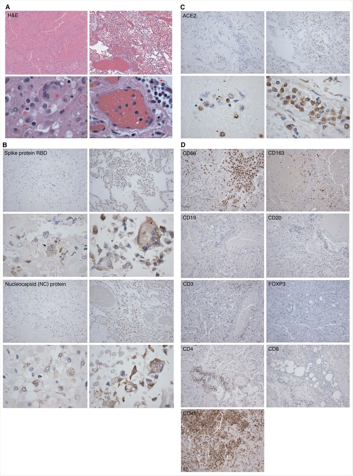 Representative hematoxylin-eosin (H&E) and immunohistochemistry (IHC) staining images of SARS-CoV-2 proteins and markers of immune cells in lung tissues from two COVID-19 patients.