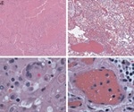 Lung tissue in fatal COVID-19 shows broad cell tropism and extensive damage