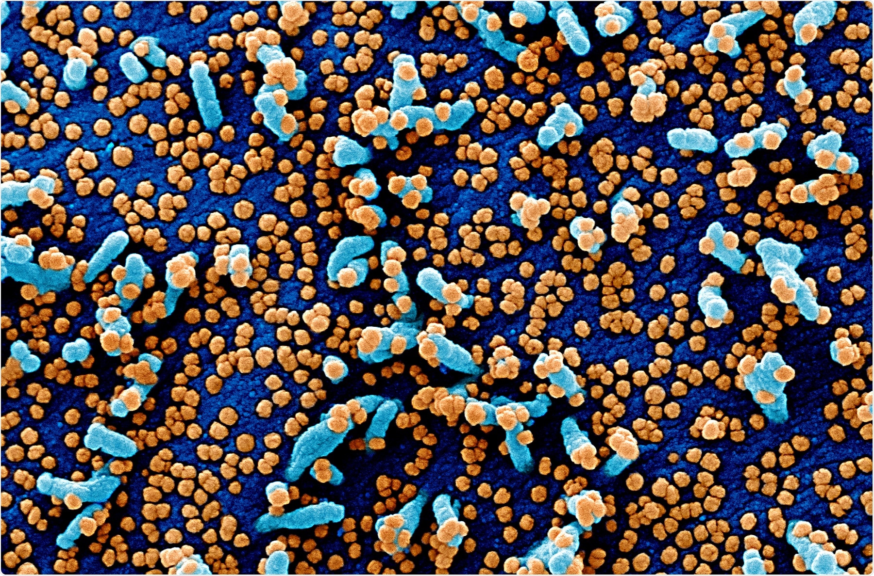 Colorized scanning electron micrograph of a VERO E6 cell (blue) heavily infected with SARS-COV-2 virus particles (orange), isolated from a patient sample. Image captured and color-enhanced at the NIAID Integrated Research Facility (IRF) in Fort Detrick, Maryland. Credit: NIAID