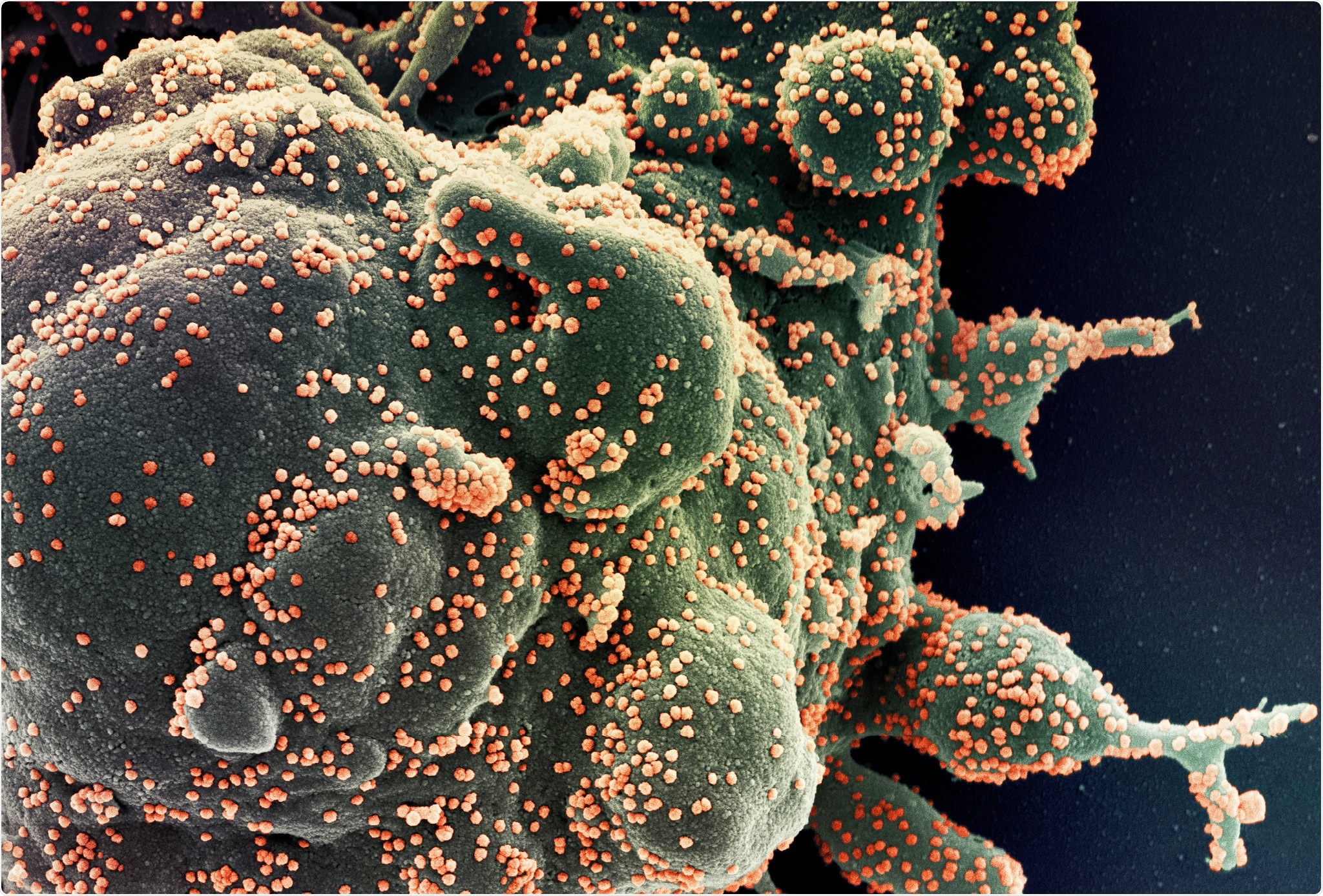 Colorized scanning electron micrograph of an apoptotic cell (green) heavily infected with SARS-COV-2 virus particles (orange), isolated from a patient sample. Image captured at the NIAID Integrated Research Facility (IRF) in Fort Detrick, Maryland. Credit: NIAID