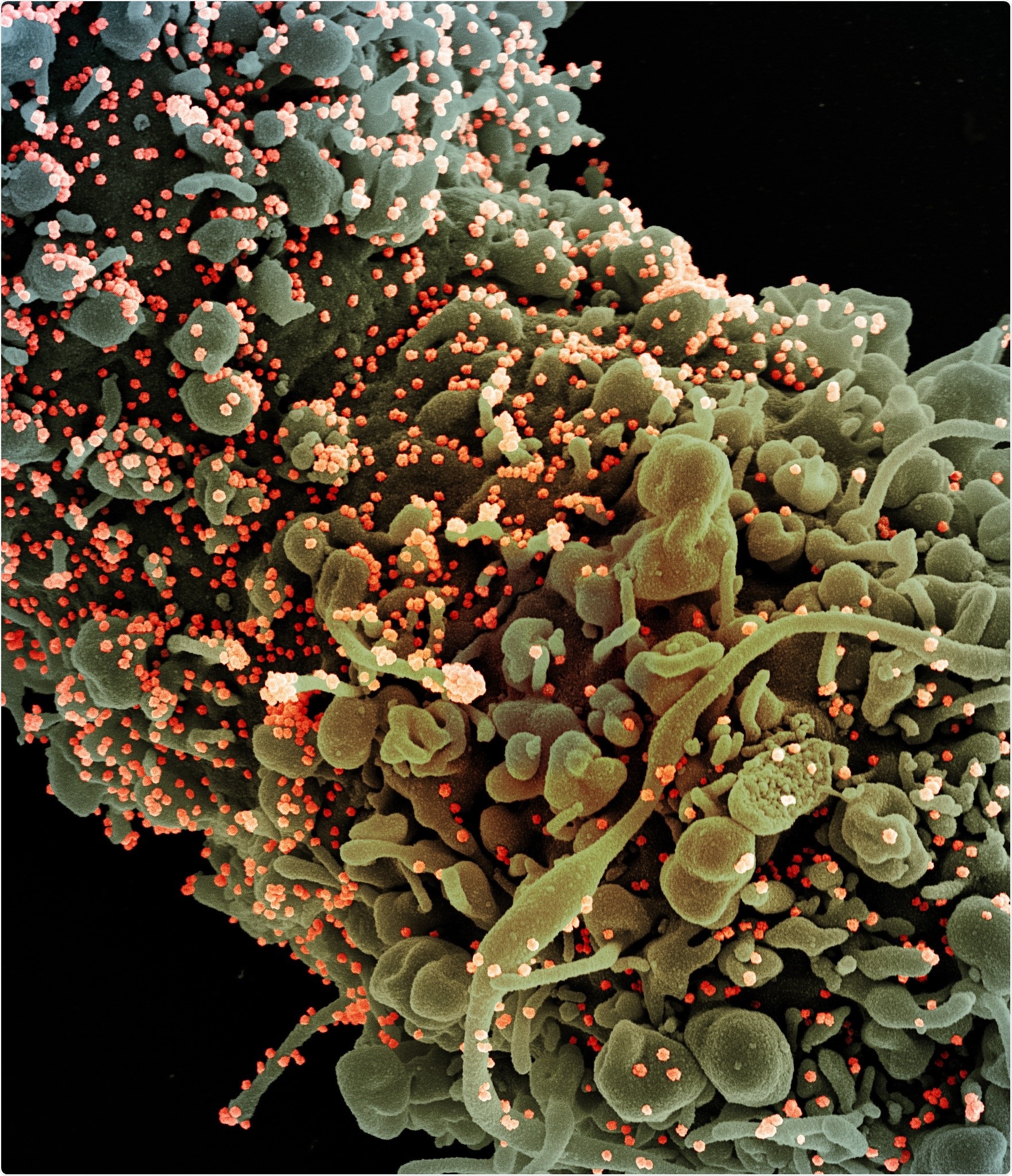 Colorized scanning electron micrograph of a cell showing morphological signs of apoptosis, infected with SARS-COV-2 virus particles (orange), isolated from a patient sample. Image captured at the NIAID Integrated Research Facility (IRF) in Fort Detrick, Maryland. Credit: NIAID/NIH