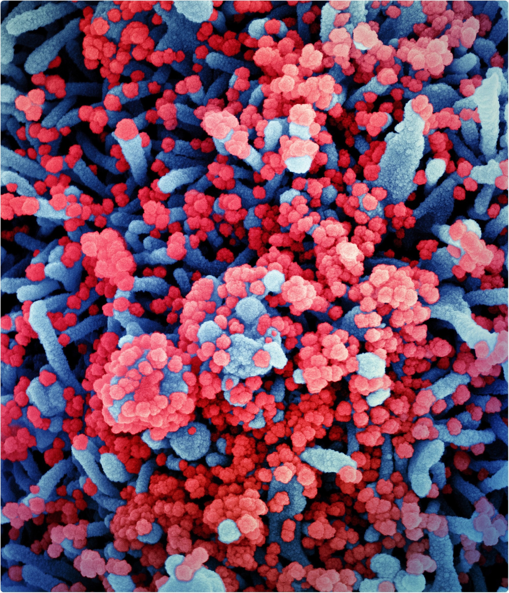 Colorized scanning electron micrograph of a cell (blue) heavily infected with SARS-CoV-2 virus particles (red), isolated from a patient sample. Image captured at the NIAID Integrated Research Facility (IRF) in Fort Detrick, Maryland. Credit: NIAID