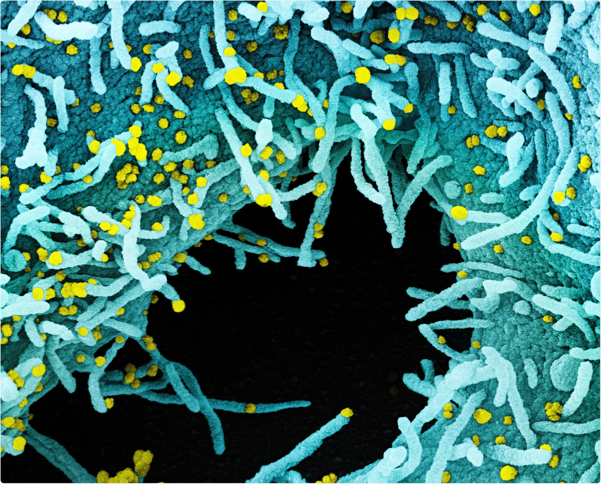 Colorized scanning electron micrograph of a cell heavily infected with SARS-CoV-2 virus particles (yellow), isolated from a patient sample. The black area in the image is extracellular space between the cells. Image captured at the NIAID Integrated Research Facility (IRF) in Fort Detrick, Maryland. Credit: NIAID
