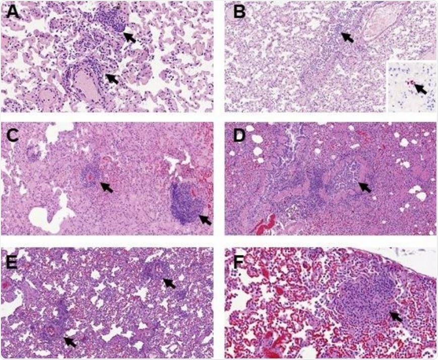 Histopathological findings in the lungs of ferrets inoculated with the UNC19 SARS-CoV-2 strain. Perivascular cuffing (A, 400x, arrows) and mild bronchiolitis (B, 200x, arrow) was observed at D2, with minimal presence of viral RNA (B, insert, 400x) within alveolar walls not related to histopathological lesions. Perivascular cuffing was also observed at D4 (C, 200x, arrows) and D7 (E, 200x, arrows). Mild bronchiolitis with presence of intraluminal inflammatory infiltrates was observed at D4 (D, 200x, arrow). Scattered foci of parenchymal inflammation were also observed at D7 (F, 400x, arrow)