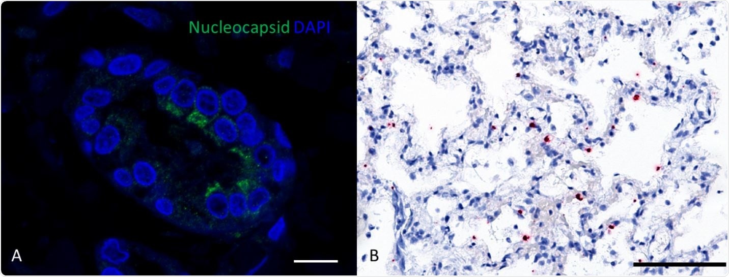 Lung of a cat infected with SARS CoV-2; a positive signal for nucleocapsid protein (green signal) was detected within the cytoplasm of the bronchiolar epithelium (A; bar, 10 µm) and viral RNA (red dots) of the spike gene was detectable in alveolar membranes (B; bar, 100 µm; haematoxylin counterstain).