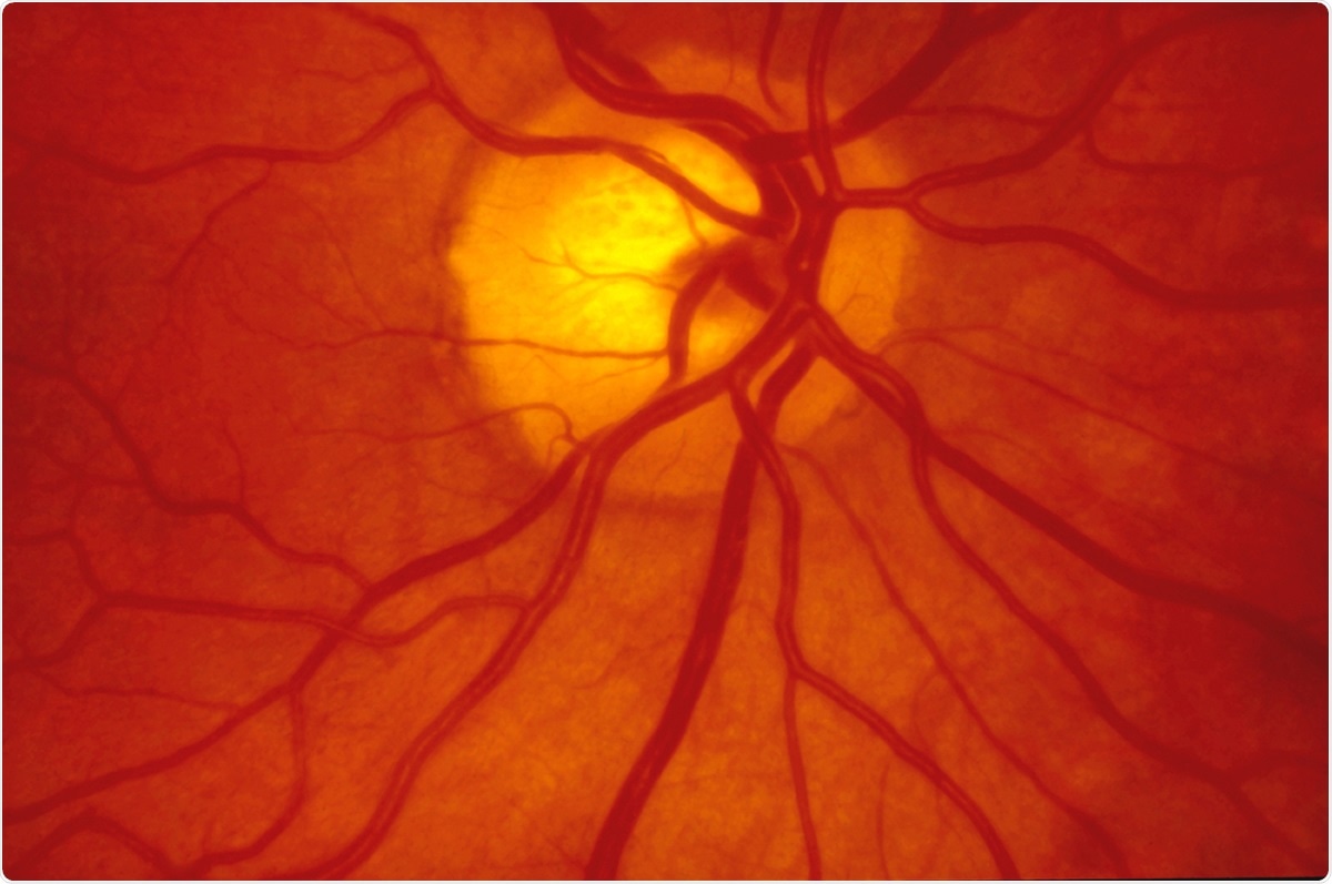 Study: Retinal findings in patients with COVID-19: Results from the SERPICO-19 study. Image Credit: Steve Allen