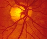 COVID-19 can affect the retina