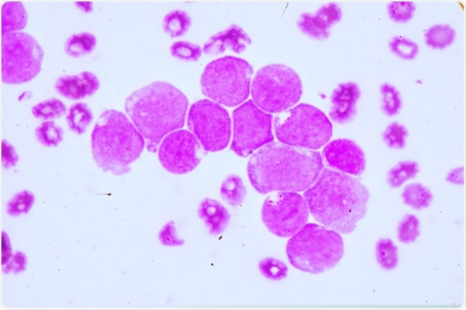 acute myeloid leukemia