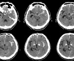 Strong causative link between smoking and bleeding in the brain