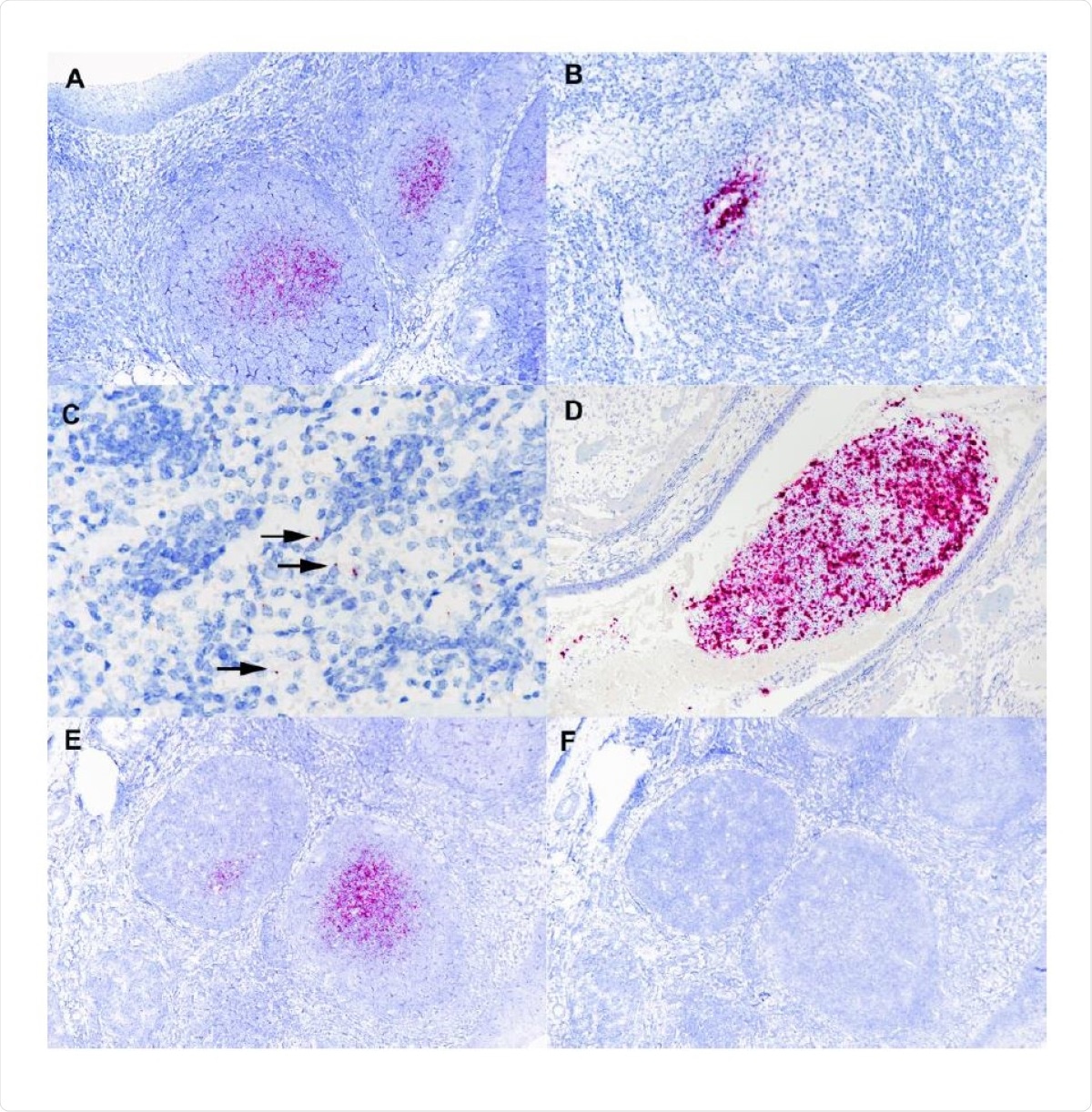 Tissues from white-tailed deer fawn inoculated intranasally with SARS-CoV-2 and examined 21 days later. Note intense labeling of viral RNA in the centers of lymphoid follicles (A) located subjacent to tonsillar epithelium (upper left). Note labeling for SARS-CoV-2 RNA within medial retropharyngeal lymph node follicle (B) and mediastinal lymph node medulla (C). Nasal turbinate lumen contains aggregate of mucus, cells and debris with intense labeling for SARS-CoV-2 RNA (D). Adjacent microscopic sections demonstrate intense labeling of lymphoid follicles with probe for SARS-CoV-2 RNA (E) but no labeling using the anti-genomic sense probe (F). ISH- RNAscope.