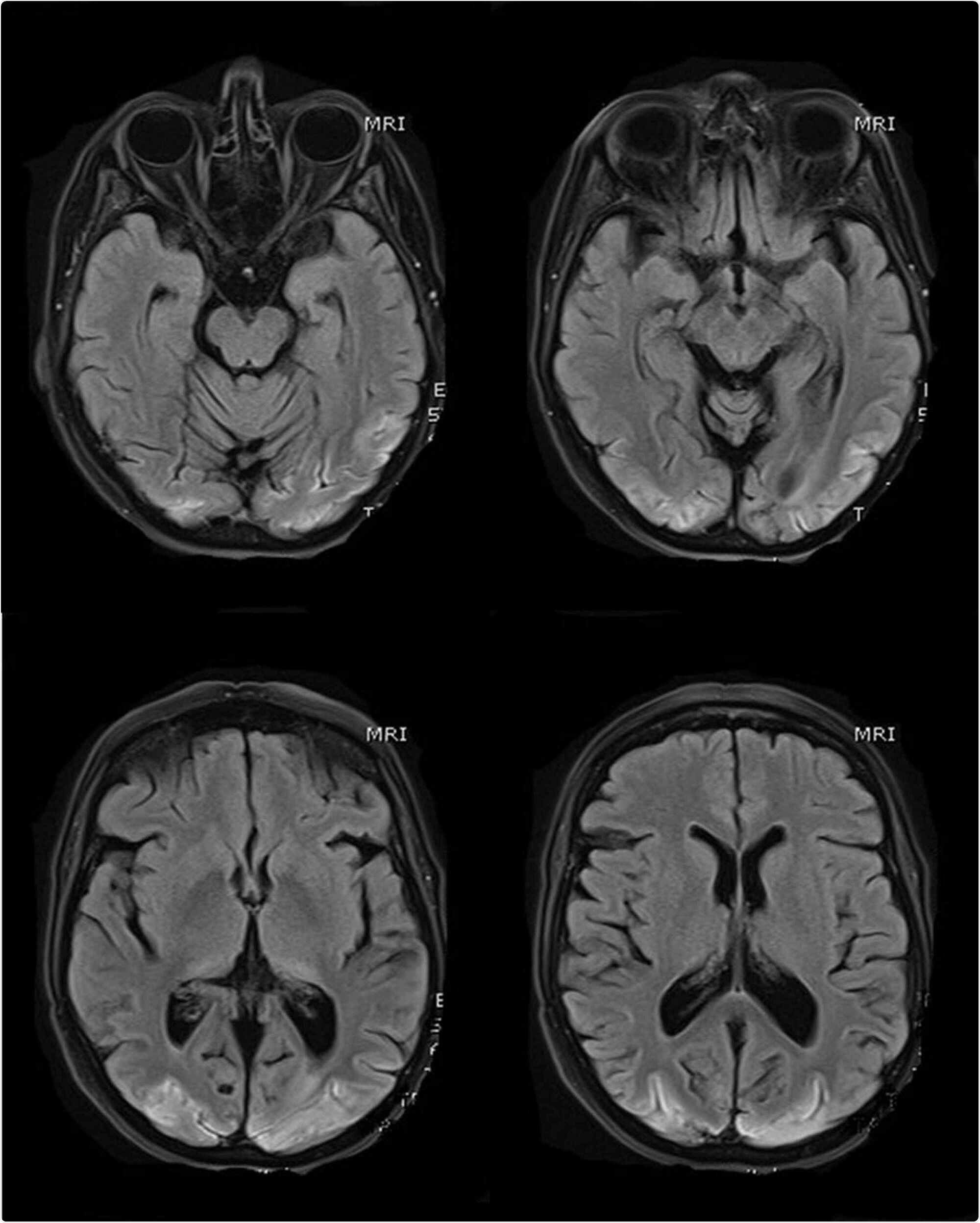 MR scans of the brain (selected T1 sequences) show bilateral symmetrical hyper-intensity involving the bilateral occipital lobe cortex; the changes are consistent with cortical pseudo-laminar necrosis as a complication of posterior reversible encephalopathy syndrome (PRES)