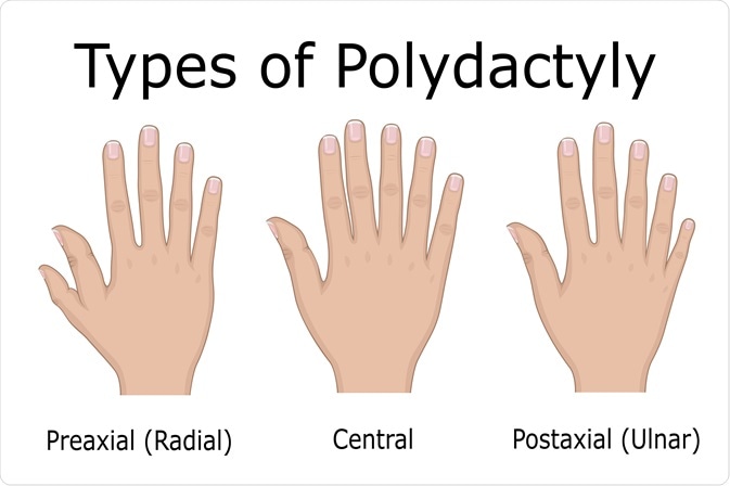 polydactyly