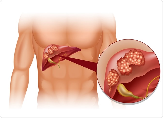 Cancro do fígado na ilustração humana. Crédito de imagem: BlueRingMedia/Shutterstock