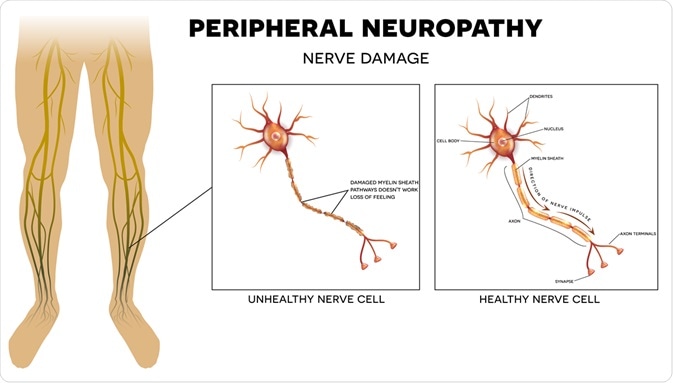Aandoeningen van het perifere zenuwstelsel: symptomen en behandeling