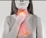 Causes of Heartburn (Acid Reflux)