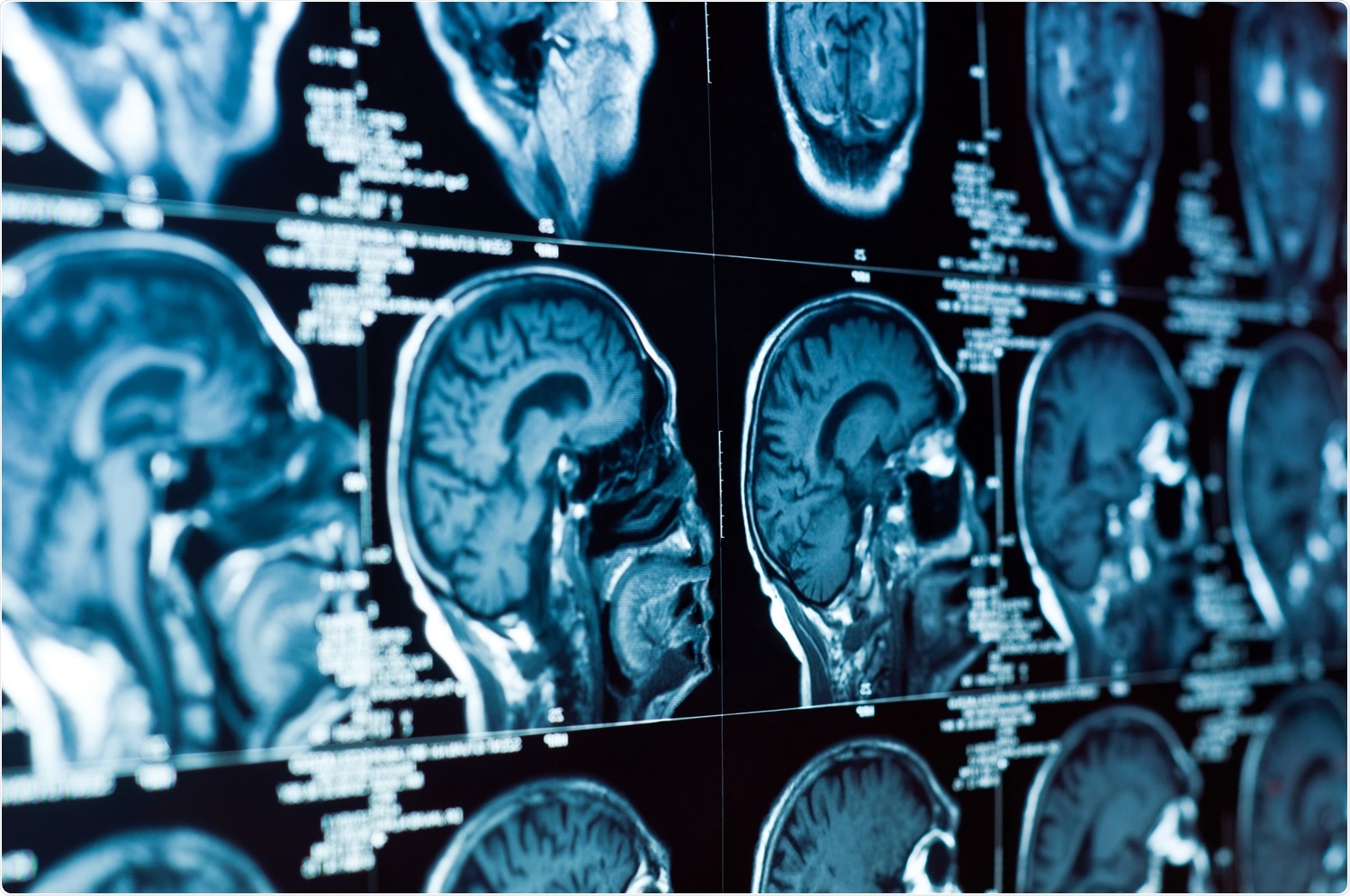 Study: Brain MRI in SARS-CoV-2 pneumonia patients with newly developed neurological manifestations suggestive of brain involvement. Image Credit: SvedOliver / Shutterstock