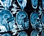 MRI study suggests link between SARS-CoV-2 and brain lesions in COVID-19 patients with pneumonia