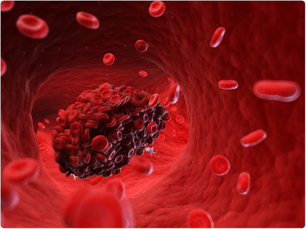 Study: SARS-CoV-2 spike protein induces abnormal inflammatory blood clots neutralized by fibrin immunotherapy. Image Credit: SciePro / Shutterstock