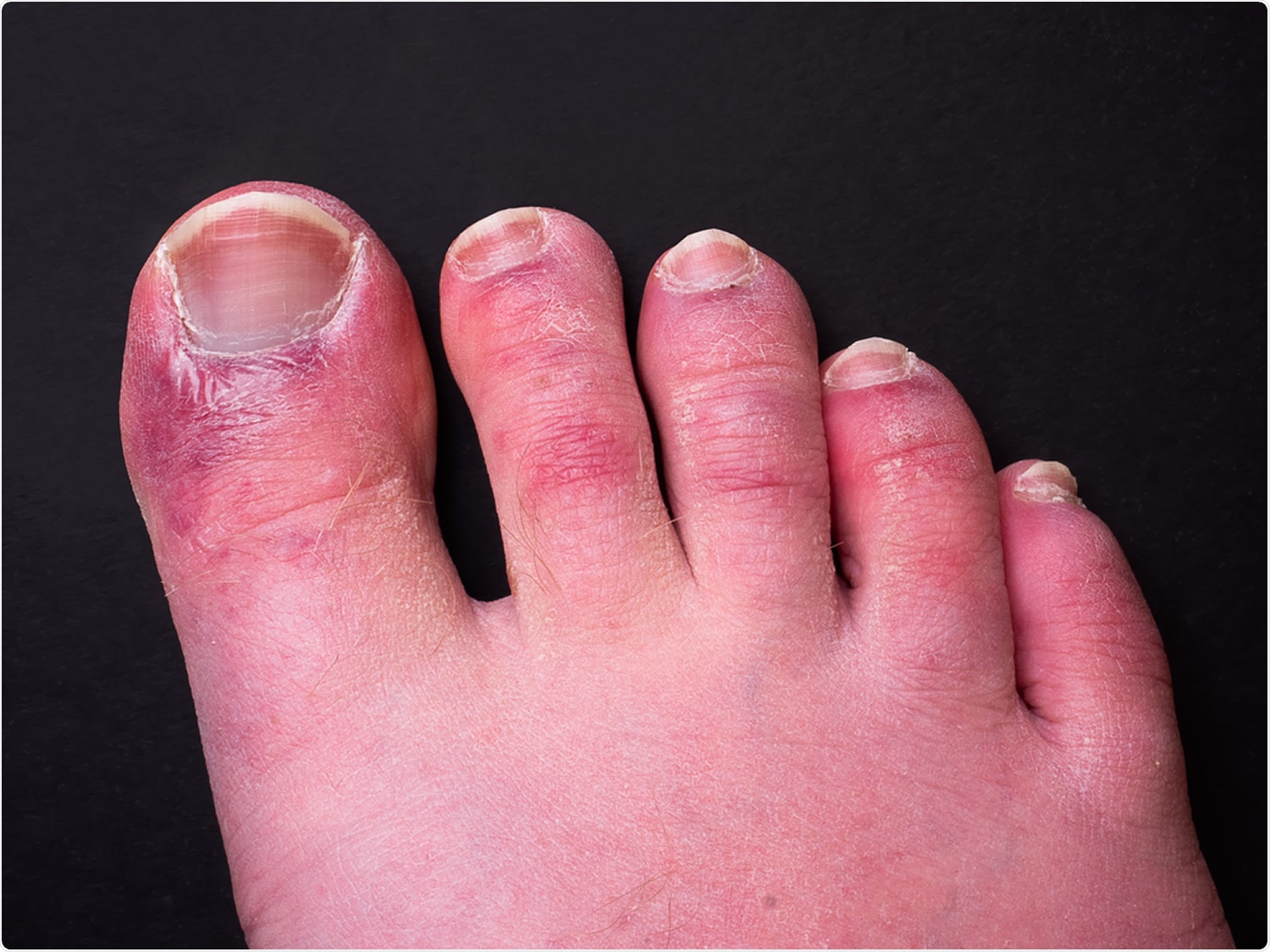 Study: Type I interferon response and vascular alteration in chilblain-like lesions during the COVID-19 outbreak. Image Credit:  Chris Curry / Shutterstock