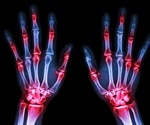 Study suggests continuous NSAID treatment more effectively reduces X-Ray progression than intermittent treatment