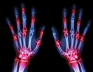 Study shows significant decreases in infections among people with psoriatic arthritis
