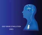 Using deep brain stimulation to treat Parkinson’s Disease