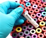 Simple blood tests may help prevent inaccuracy in the diagnosis of severe malaria