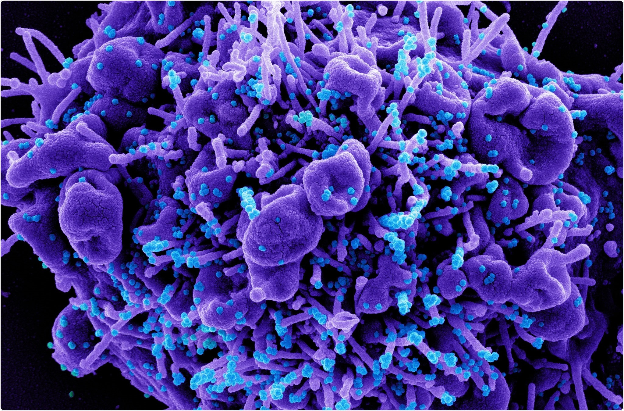 Study: De novo emergence of a remdesivir resistance mutation during treatment of persistent SARS-CoV-2 infection in an immunocompromised patient: A case report. Image Credit: NIAID
