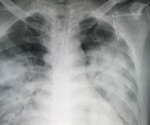 Inhaled prostacyclin improves oxygenation in acute respiratory distress syndrome patients