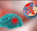 Assessing optimal stroke treatment using CTA imaging