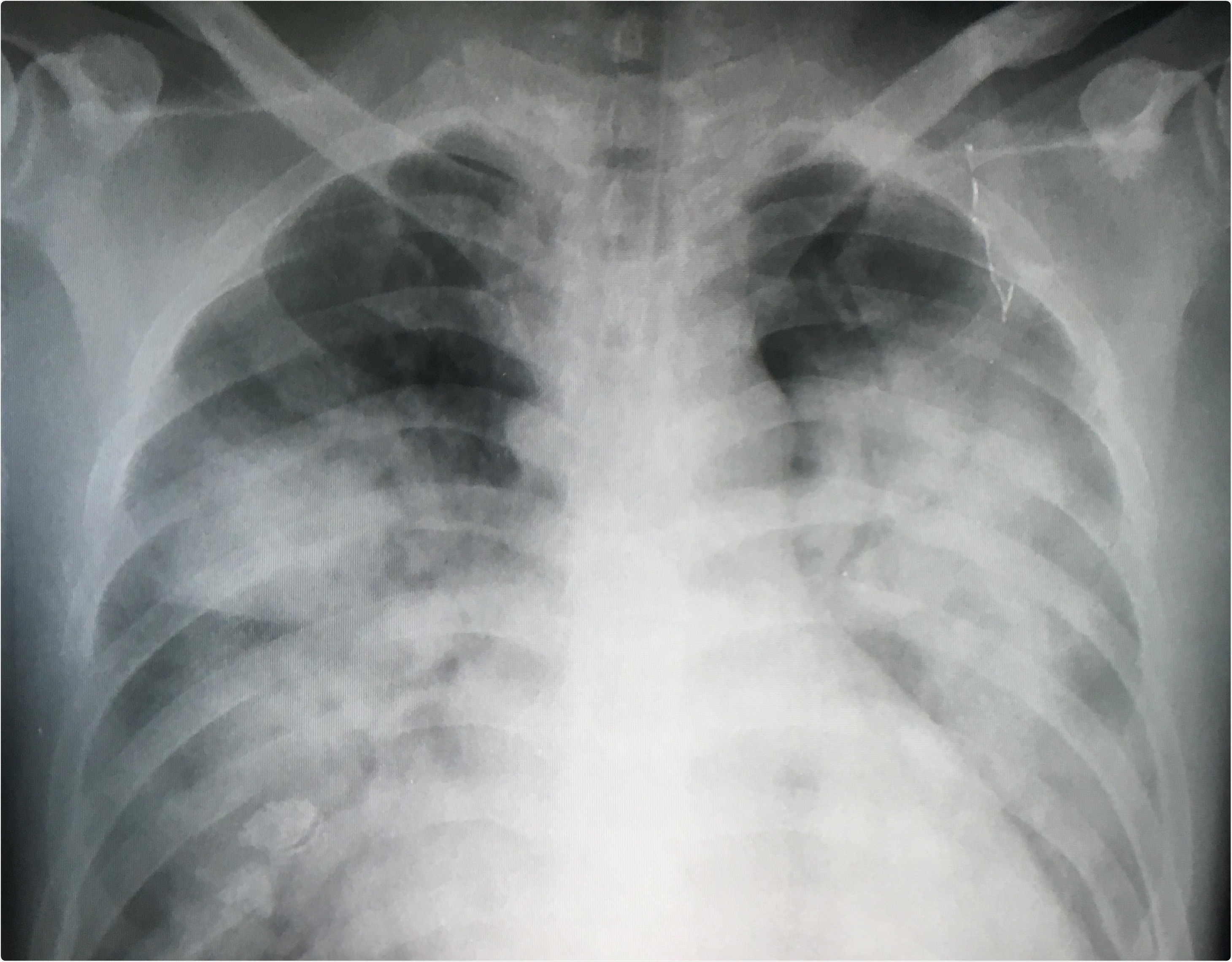 Study: Inhaled Prostacyclin Improves Oxygenation in Patients with COVID-19-induced Acute Respiratory Distress Syndrome. Image Credit: Kotcha K / Shutterstock