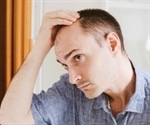What is Male Pattern Baldness?