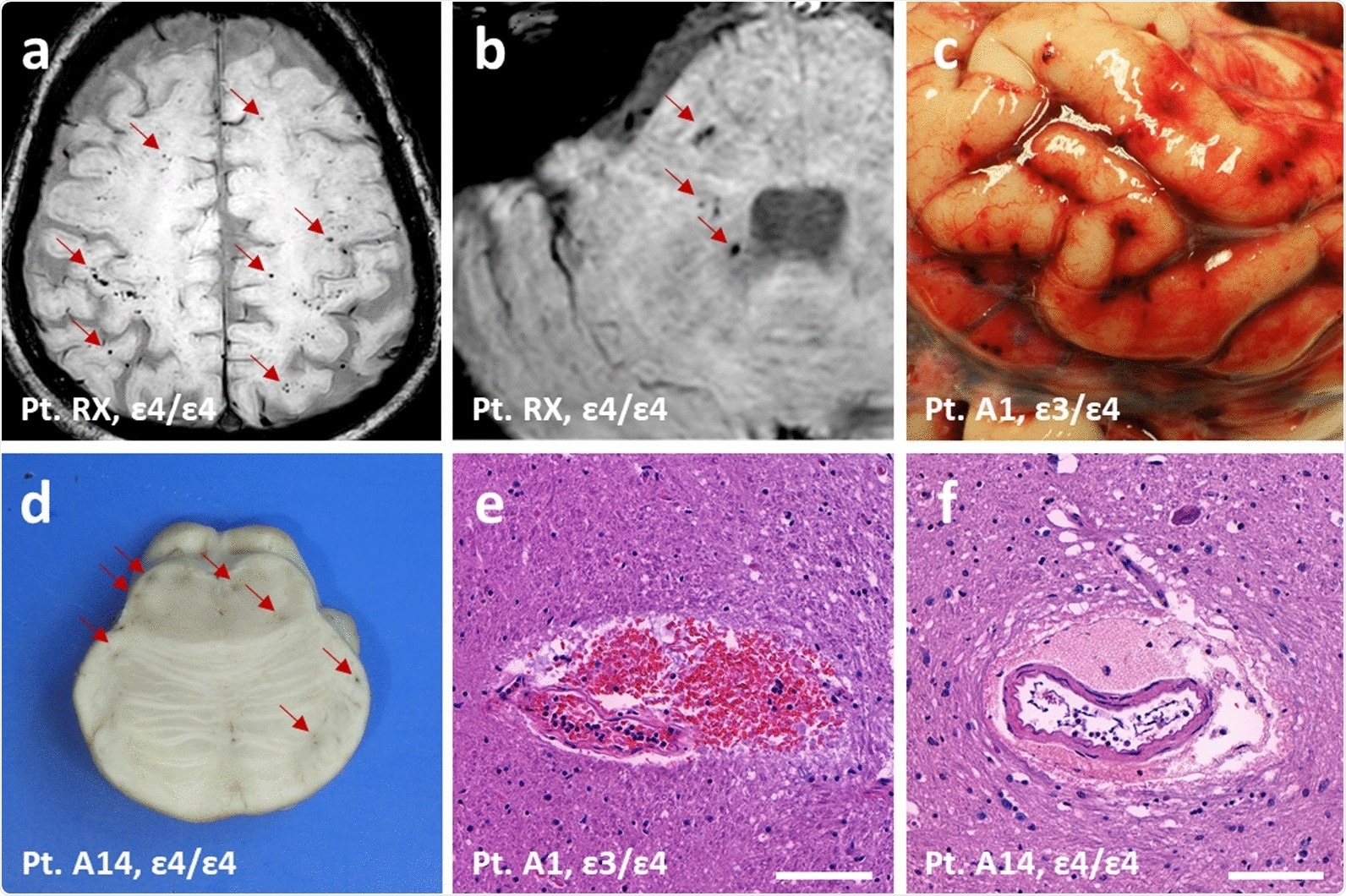 Microvascular brain haemorrhages in RECOVID and AUTOPSY cohorts. a MRI showing cortical microhaemorrhages in a case with APOE ε4/ε4. b MRI showing cerebellopontine microhaemorrhages in the same case as (a). c Brain subarachnoidal microhaemorrhages at autopsy in a case with APOE ε3/ε4. d Brain pontine microhaemorrhages at neuropathological examination in a case with APOE ε4/ε4. e Histological H&E section showing pontine microhaemorrhages in the same case as (c). f Histological H&E section showing pontine microhaemorrhages in the same case as (d). Red arrows indicate microhaemorrhages. Scale bars represent 100 μm in (e) and (f)