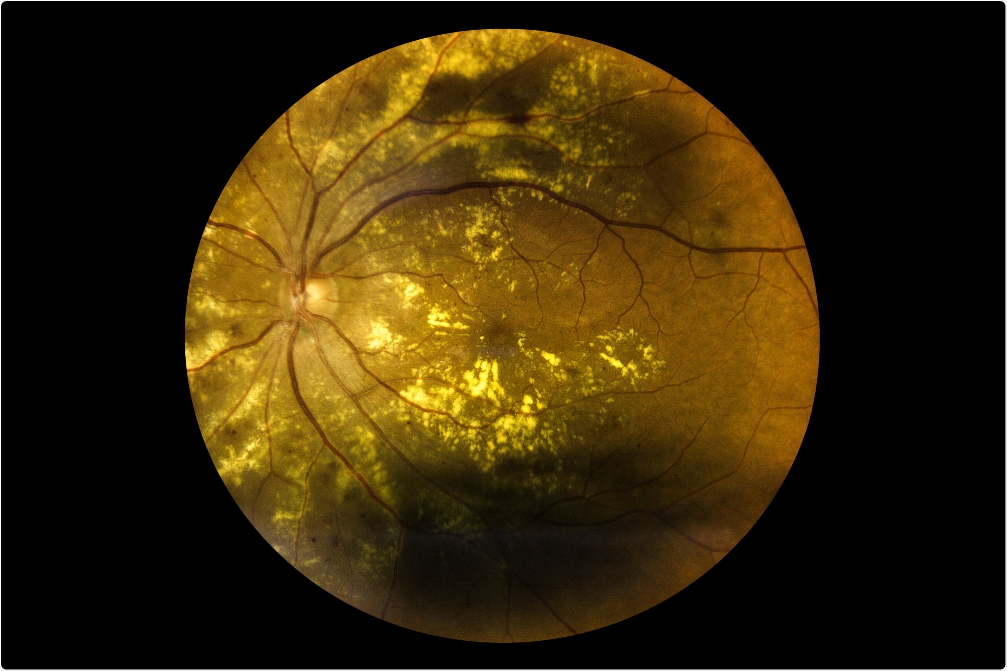 UVA researchers uncover common link between lupus and macular degeneration