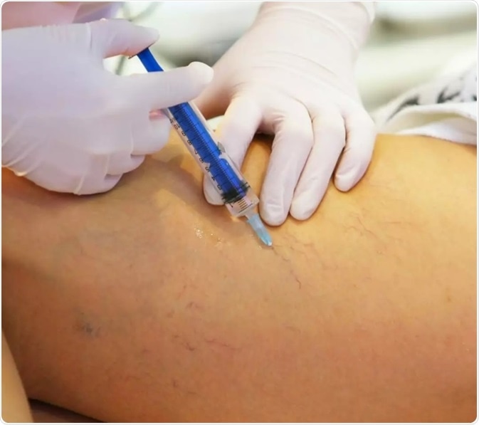 Foam sclerotherapy can be used to treat underlying vein conditions or as a secondary treatment to EVLA
