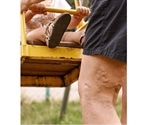 How to get rid of varicose veins