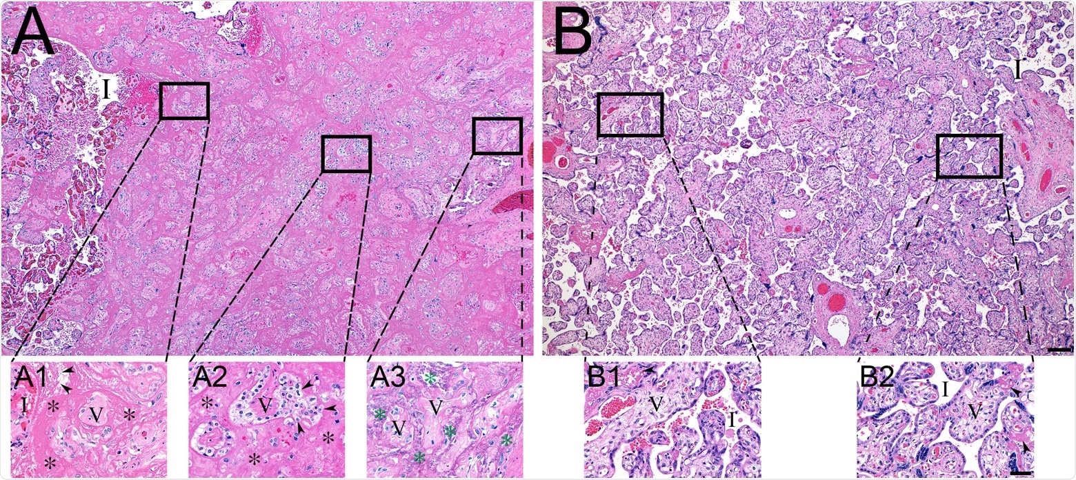 Histopathology of representative COVID-19 (A) and matched control (B) placentas. (A) COVID-19 placenta at low magnification revealed extensive intervillous fibrin deposition, with only occasional areas of open intervillous (I) spaces. (A1) High magnification at edge of blood filled intervillous space (I) and the earliest fibrin deposition (asterisks). Trapped chorionic villi (V) have become avascular and fibrotic. Initial fibrillar fibrin (arrow heads) can be seen at the blood-fibrin interface. (A2) Older area of intervillous fibrin (asterisks) and trapped villi (V) revealing migration of trophoblasts (arrow heads) into the fibrin matrix. (A3) Oldest area of intervillous fibrin became calcified (green asterisks), encasing villous remnants (V). (B) In sharp contrast, the control placenta revealed virtually no fibrin in the intervillous space (I). (B1 and B2) Representative magnified areas revealed normal villi (V) and open, maternal blood containing intervillous space (I), with only occasional foci of fibrin formation (arrow heads). Bars represents 200 μM for images A and B and 50 μM for images A1-B2.