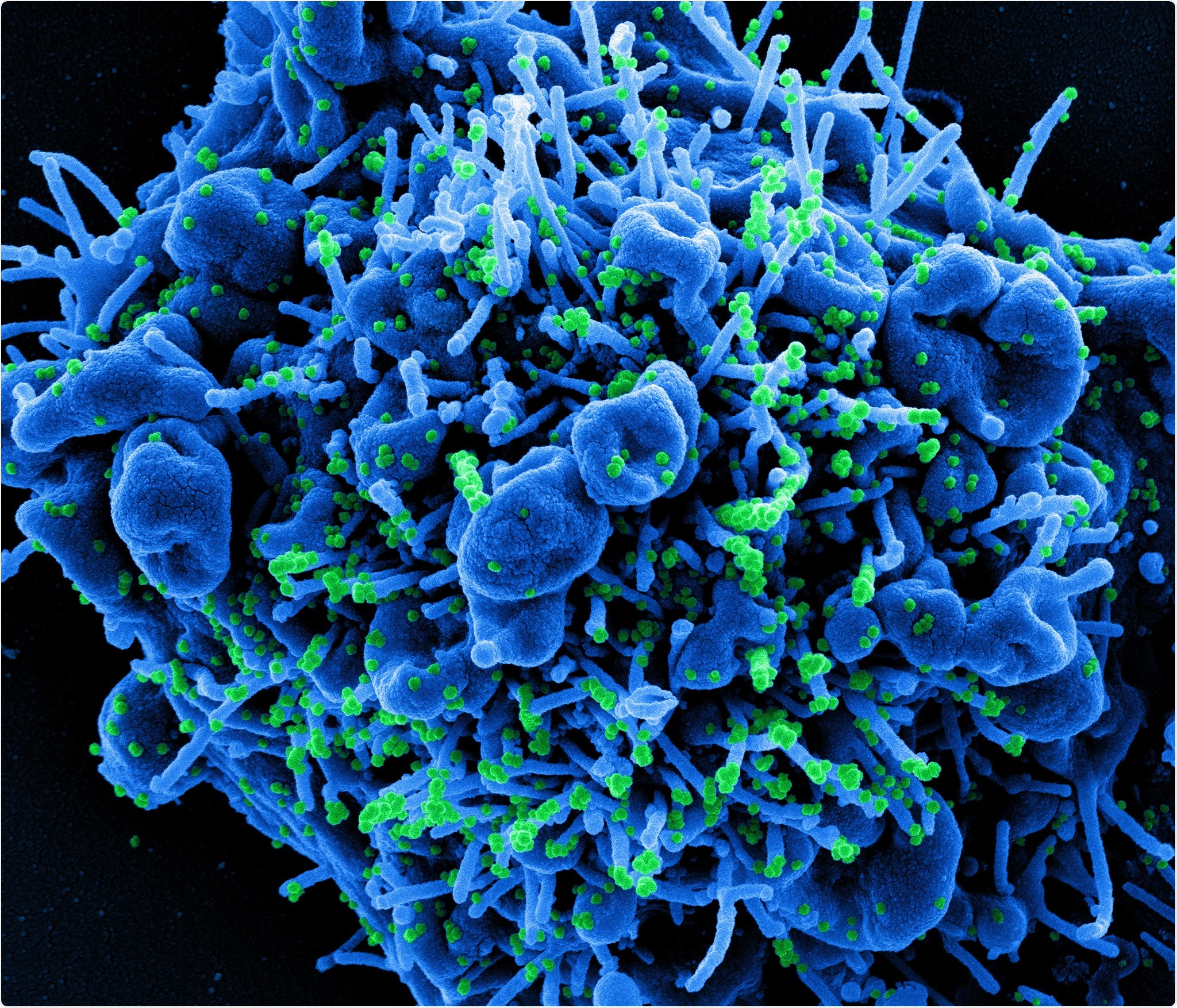 Colorized scanning electron micrograph of an apoptotic cell (blue) infected with SARS-COV-2 virus particles (green), isolated from a patient sample. Image captured at the NIAID Integrated Research Facility (IRF) in Fort Detrick, Maryland. Credit: NIAID
