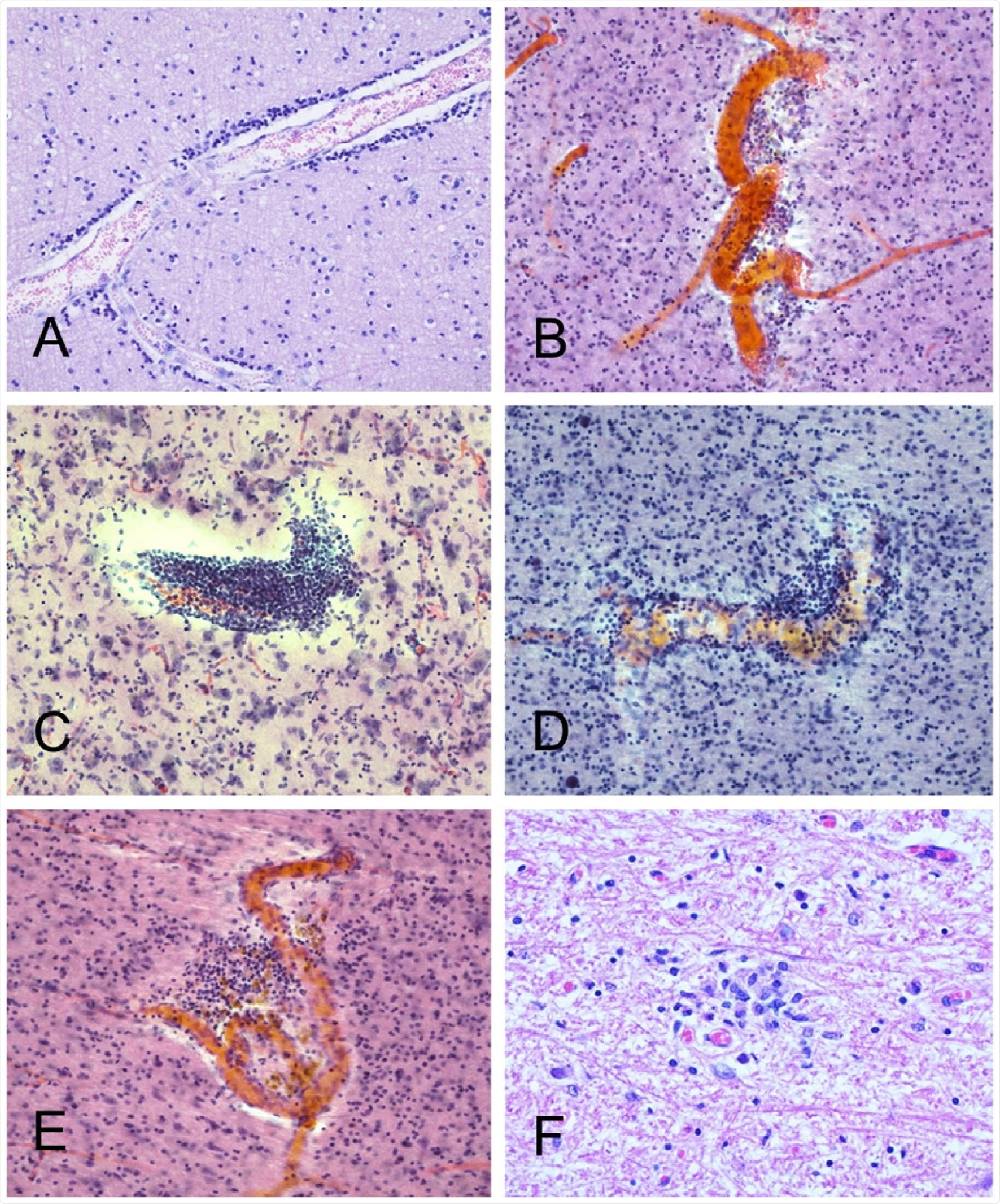 Several cases had occasional perivascular mononuclear cell aggregates, in both gray and wh matter. Shown are examples from BSHRI Case B4, a male in his 80s(A), Case B2, a female in her 70s Case B6, a male in his 70s (C), Case B8, a male in his 80s(D), and Case B9, a male in his 70s (E). Also is a microglial nodule in the posterior medulla in the region of the nucleus gracilis, in BSHRI Case B6 (F) Images are from H & E-stained 80 μm thick sections (B-E) or 6 μm paraffin sections (A, F).