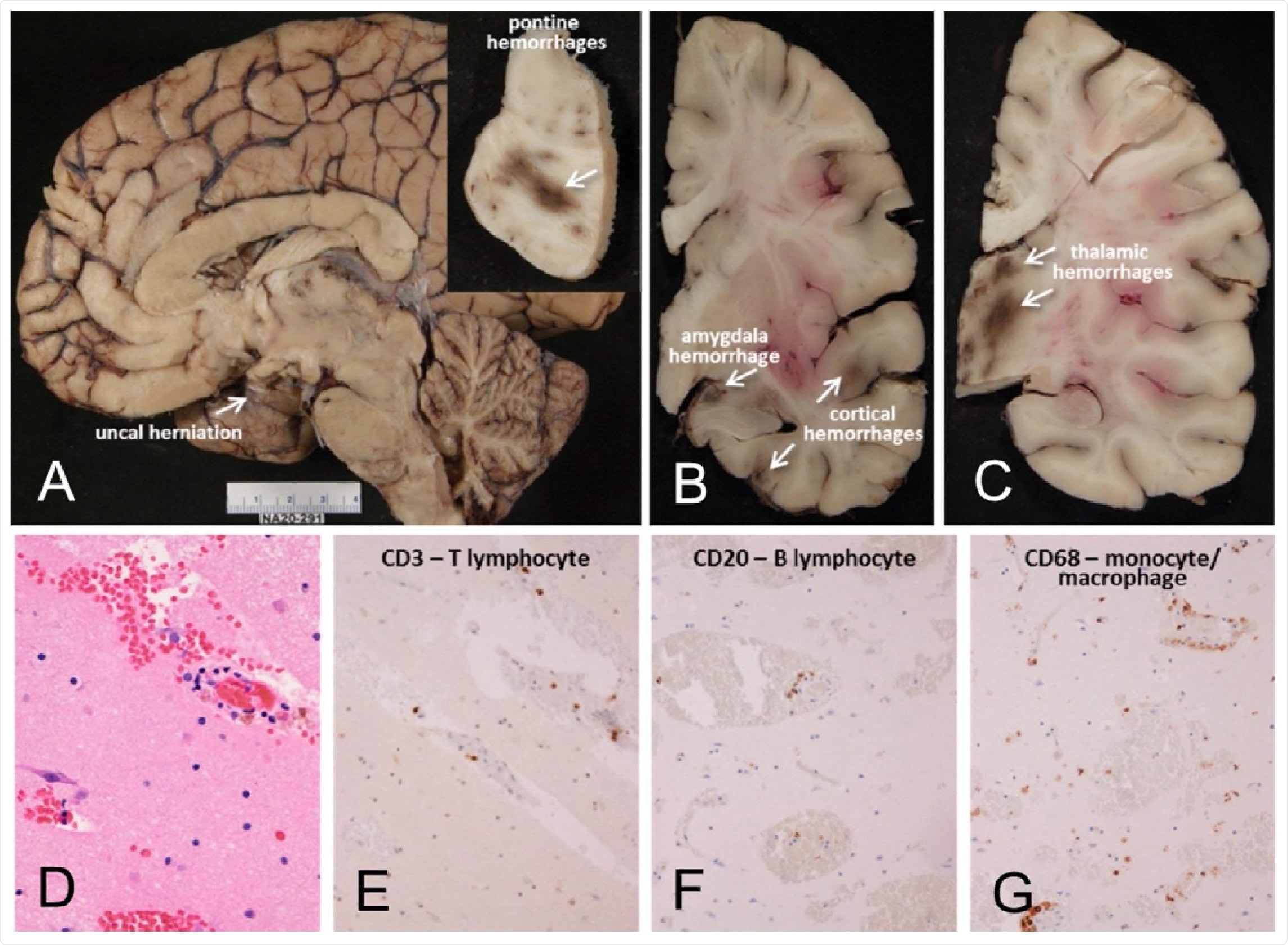 Mayo Clinic Case M10 (see Tables), a male in his 30s. Neuropathological gross examination consistent with encephalitis-associated brain swelling causing transtentorial uncal herniation (A) and associated with acute hemorrhages (arrows A inset, and in B and C). Microscopic examination of semiadjacent temporal lobe sections show microscopic hemorrhage (D; H & E stain) and neuropil infiltration w and B-lymphocytes and macrophages (E-G)