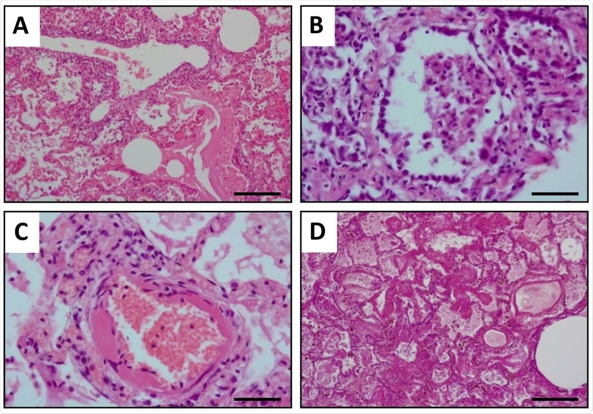 Histopathological study of lung tissues in sick dogs. Representative images of hematoxylin and eosin stained necropsy samples are shown. A Sample showing moderate vasculitis with rich-protein alveolar oedema and haemorrhages. B Lung tissue showing alveolar lined by type II pneumocytes and inflammatory infiltrate in the alveolar lumens. C Arteriolar wall hyalinosis is shown. D Diffuse alveolar damage with oedema and intra-alveolar hyaline membranes are shown. Scale bar: 200 μm (A, D) and 50 μm (B, C).