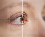 Visual Abberations After Laser Eye Surgery (LASIK)